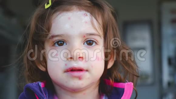 水痘儿童面部肖像病视频的预览图