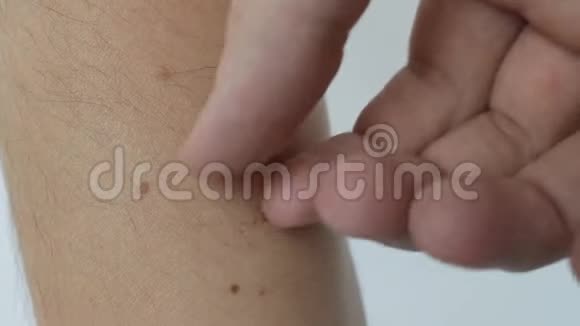 一个人在伤口上撕下一层皮壳医疗疼痛年轻视频的预览图