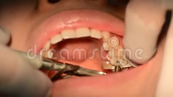 4K用汞合金将牙齿上的口腔填充物和牙冠封闭起来视频的预览图