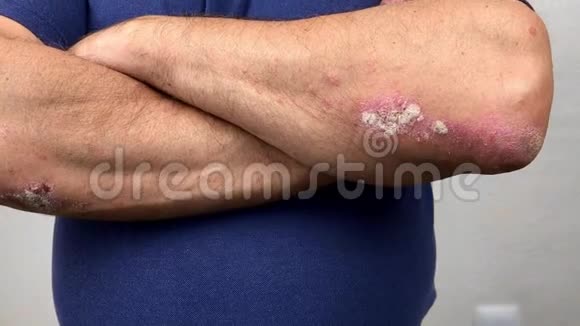 有银屑病和湿疹的老人手指皮肤剥落的特写视频的预览图
