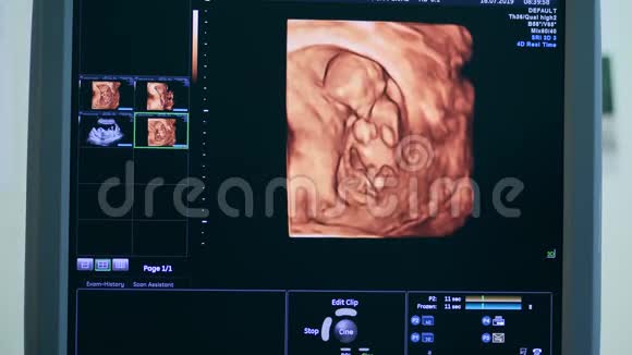 带有胎儿超声图像的计算机屏幕视频的预览图