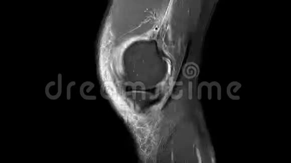 左膝韧带断裂的MRI扫描视频的预览图