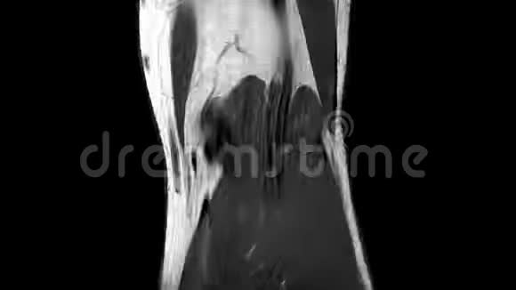 左膝韧带断裂的MRI扫描视频的预览图