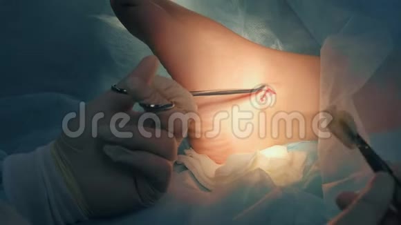 利用医疗工具进行踝关节湿疣手术视频的预览图