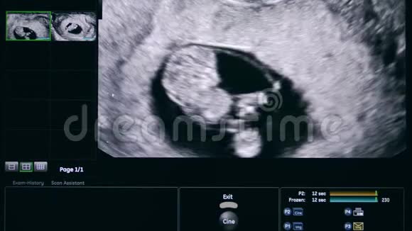 超声波图像上的未出生婴儿视频的预览图