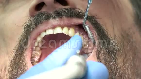 牙医清洁牙齿视频的预览图