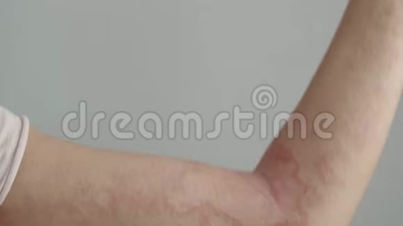 女人用皮炎抓她的手臂视频的预览图