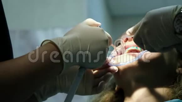 牙科医生在安装托槽系统之前将牙齿的正畸蓝色凝胶放入固定器中视频的预览图