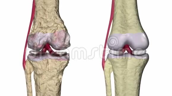 骨关节炎膝关节伴韧带和软骨视频的预览图