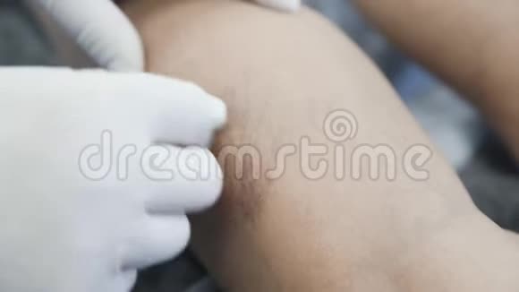 手术前静脉曲张患者腿部消毒时手套中血管外科医生的近手视频的预览图