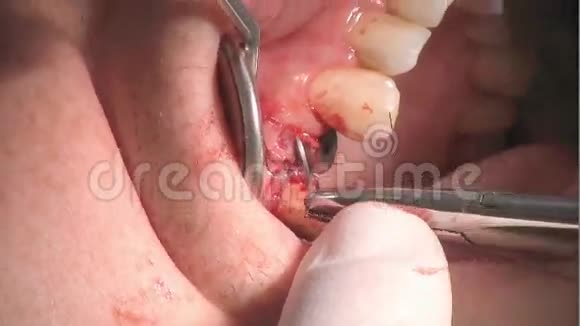 口腔手术植入物视频的预览图