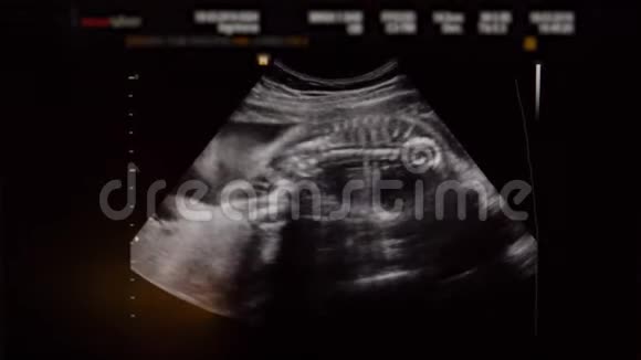 孕中期婴儿超声检查视频的预览图