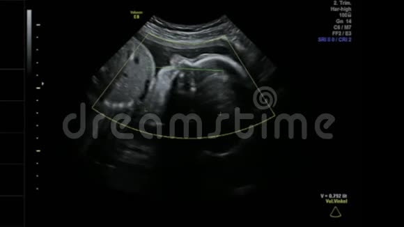 婴儿女孩在母亲子宫里平静地睡觉26周超声波扫描视频的预览图