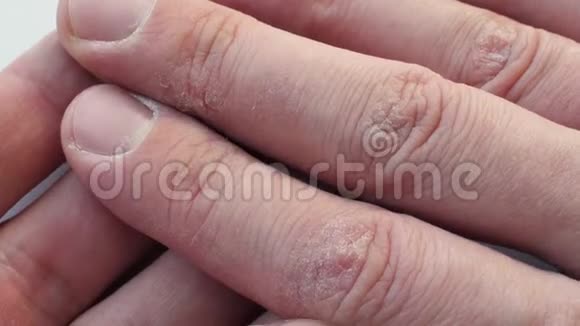 手指有干裂的皮肤手有皮肤科问题视频的预览图