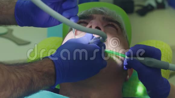 根管治疗过程医生用手钻牙视频的预览图