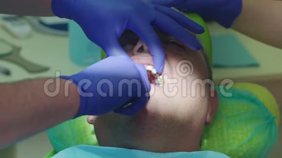 牙齿植入剥离过程关闭牙科医生的手去掉义齿视频的预览图