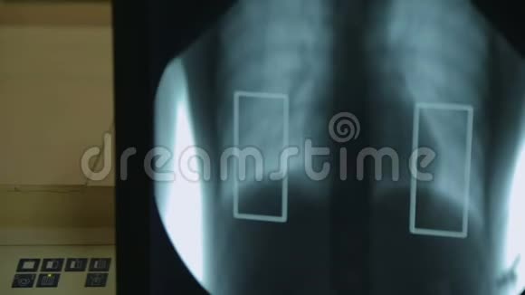 放射科医生检查肺炎患者的X光提供治疗视频的预览图