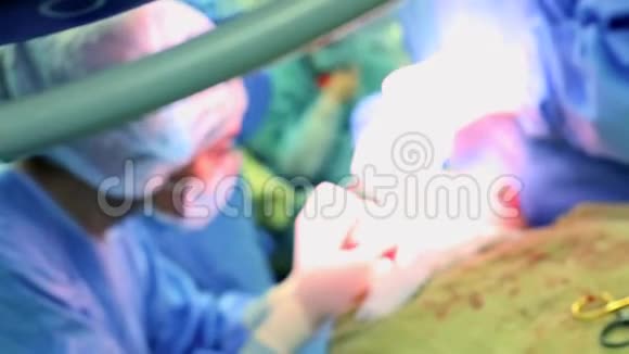 医院手术室一支多元化的专业外科医生和护士队伍成功后缝合伤口视频的预览图