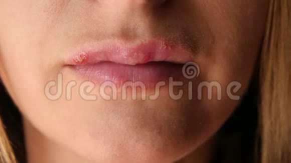 女人触摸嘴唇上疱疹带来的疮女性唇部溃疡疱疹特写美丽的嘴唇上布满了视频的预览图