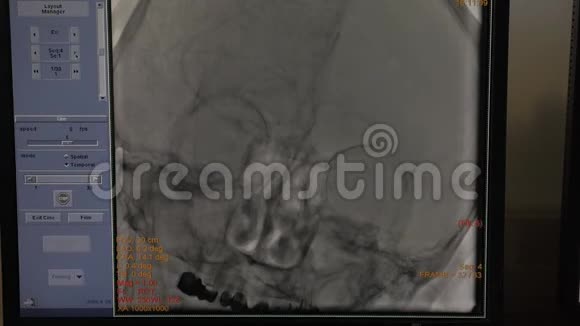 监视器显示病人大脑操作过程中的状况视频的预览图