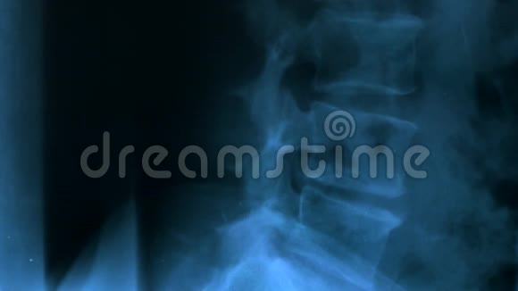 研究脊椎下腰部骨骼X线的医生视频的预览图