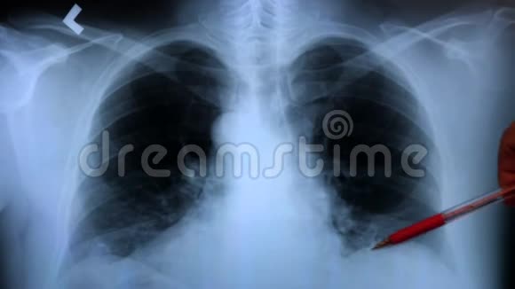 Octor检查病人肺部x线视频的预览图