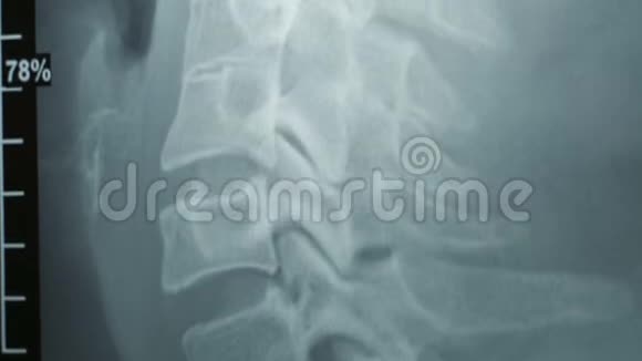 医生检查一个病人脊柱x光健康轻松的男人视频的预览图