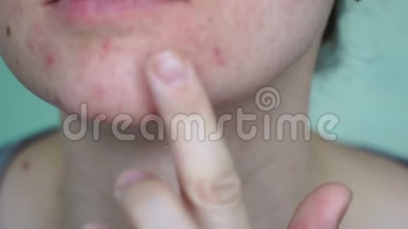 皮肤有问题的女人脸上的大疙瘩要涂上药膏视频的预览图
