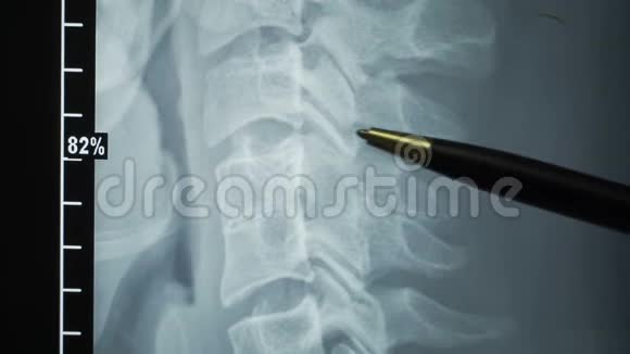 一位医生正在研究脊柱X线病人有椎骨视频的预览图