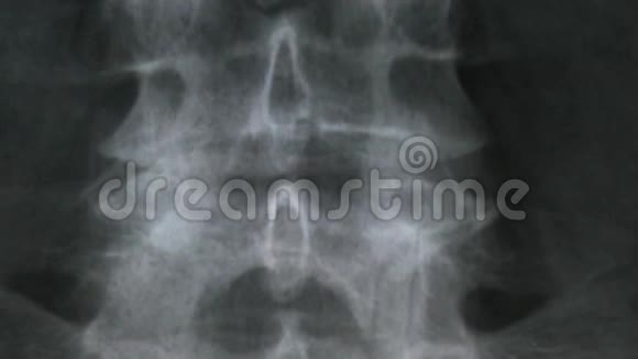 人体脊椎骨和骨盆的X线片视频的预览图