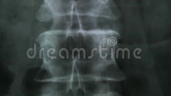 研究人体脊椎骨X线的医生视频的预览图