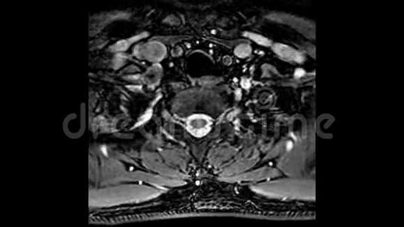 颈椎MRI扫描脊柱突出和疝的检测视频的预览图