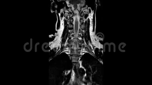 颈椎MRI扫描脊柱突出和疝的检测视频的预览图