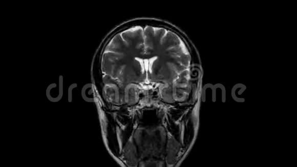 脑MRI头部扫描和肿瘤检测诊断医疗工具视频的预览图