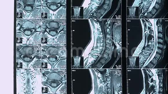 女医生指着病人向实习生讲述疾病的脊柱核磁共振视频的预览图