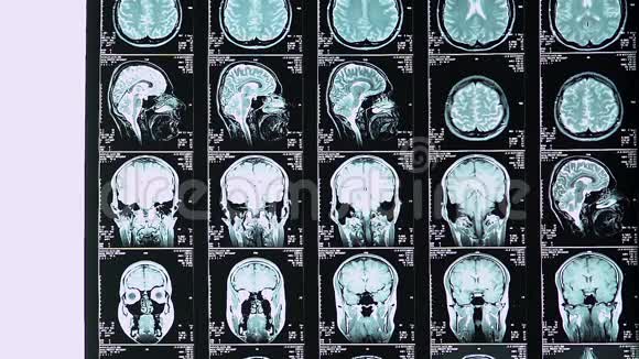 年轻神经外科医生在MRI扫描中计算脑震荡患者的程度视频的预览图