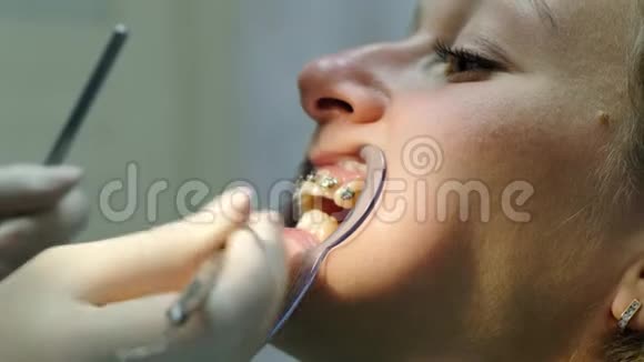 去看牙医医生正畸师为一位口腔内有固定器的妇女安装了铁支架视频的预览图