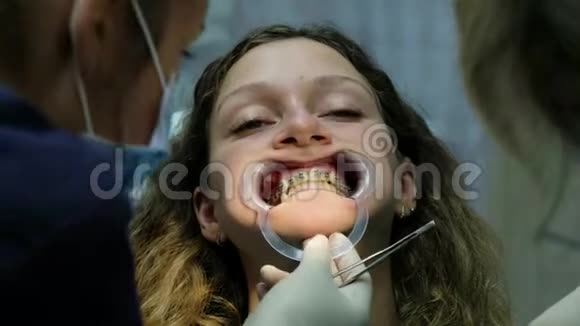 安装金属牙套特写拜访牙医正畸医生检查安装的牙套系统视频的预览图