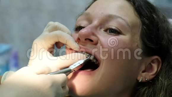 拜访牙医安装支架系统正畸牙安装金属正畸牙弓上有钳视频的预览图