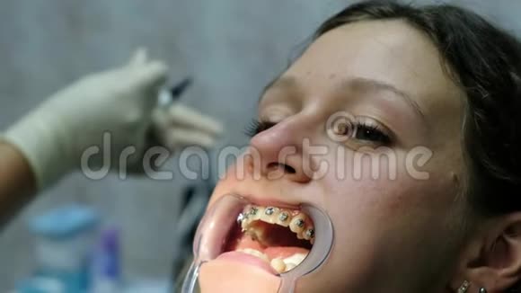安装金属牙套特写拜访牙医牙齿矫正师在牙齿上盖上印章和贴片视频的预览图