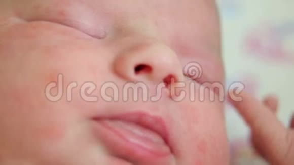 在医院的床上躺着一个皮肤过敏的新生儿的特写视频的预览图