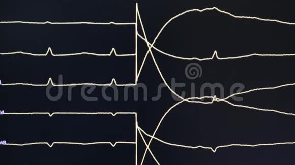 监视器上心脏的心电图视频的预览图