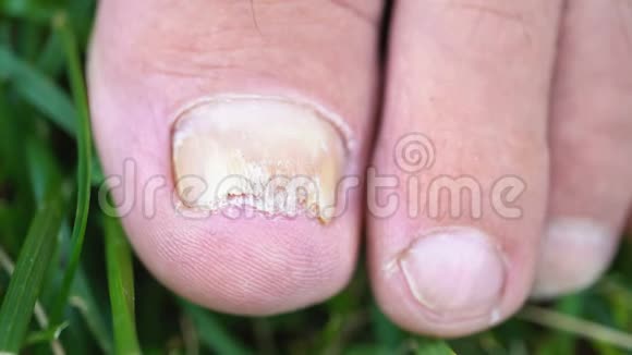 脚指甲真菌感染视频的预览图