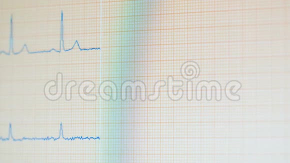 心电图改变的医学监视器心电监护仪显示健康心跳视频的预览图
