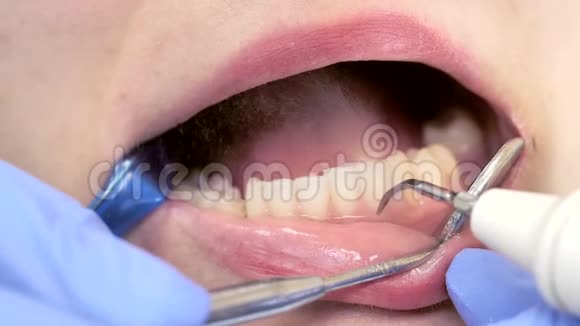 牙科医生在一个真正的牙科手术中为病人牙齿做特写视频的预览图