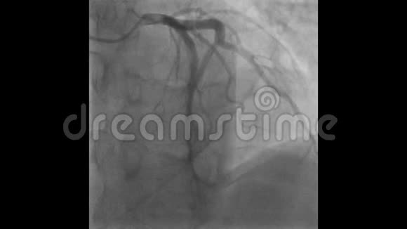 冠状动脉造影视频的预览图