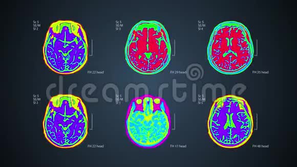 脑MRT扫描一个屏幕上有6个视图4k医用彩色背景视频的预览图
