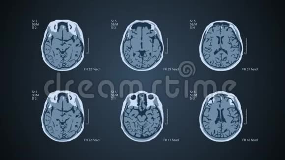 脑MRT扫描一个屏幕上有6个视图4k医用蓝色背景视频的预览图