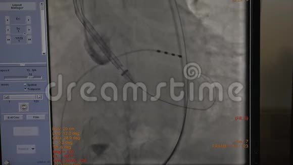 心电监护仪显示病人在心脏手术的情况视频的预览图