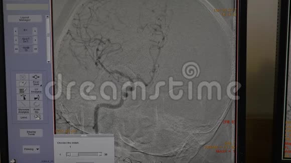 监视器显示病人大脑操作过程中的状况视频的预览图